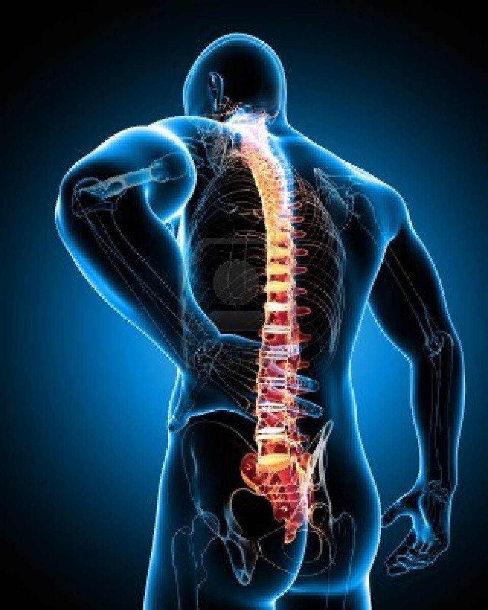 escoliosis